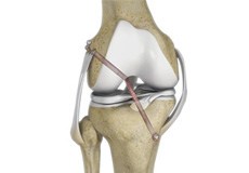 Arthroscopic Reconstruction of the Knee for Ligament Injuries