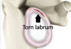 Shoulder Labrum Tear