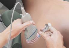 Ultrasound Guided Shoulder Injections